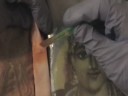 Sharp Debridement Video Sharp Debridement Video