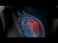 West Los Angeles Chiropractor / Rotator Cuff and Shoulder Pain Relief