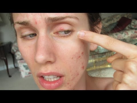 how to get rid eye pimple