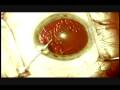 Modern & Painless Cataract Surgery