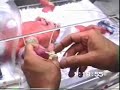 Spring loaded device can ease cannula introducing technique. The success rate of introducing cannula in the first attempt is very high. This video clip demonstrate how this technique can be atraumatic when compared with present method.The number of attempts must be minimal to reduce spreading antibiotic resistant superbug entering blood vessels.