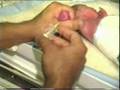 Introducing IV Cannula Made Easy