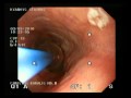 Stenosis Of The Esophagus - Dilatation Stenosis Of The Esophagus - Dilatation