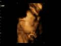 3D Ultraschall