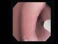 Brush Cytology Lung