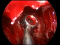 Brain Surgery: Pituitary tumor. Christopher Duma, MD and Tim Kelley, MD