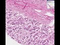 Histopathology Adrenal--Atrophy Histopathology Adrenal--Atrophy