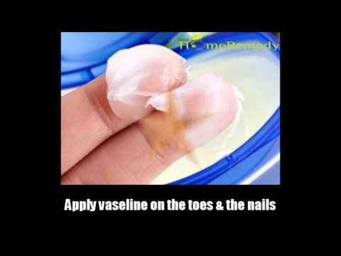 how to cure a ingrown toenail