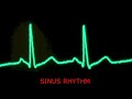audible heart beat - extrasystoles / PVC and sinus beats audible heart beat - extrasystoles / PVC and sinus beats