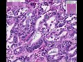 Histopathology Kidney, Liver, Heart--Pancreatic Carcinoma Histopathology Kidney, Liver, Heart--Pancreatic Carcinoma