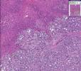 Histopathology Kidney, Liver, Heart--Pancreatic Carcinoma