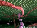 Metastasis Cancer