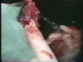 SPN, nodulo polmonare solitario, adenocarcinoma