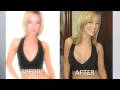 Jen's Breast Implants Procedure By Dr. Leonard M. Hochstein