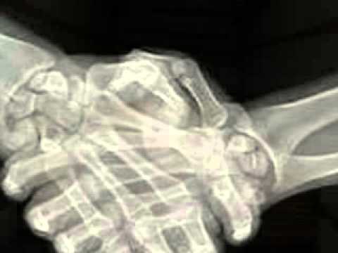 how to properly dispose of x ray films