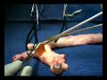 Aortic Arch substitution in less than ONE MINUTE