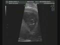 videos de Larissa's Ultrasound @ 12 weeks
