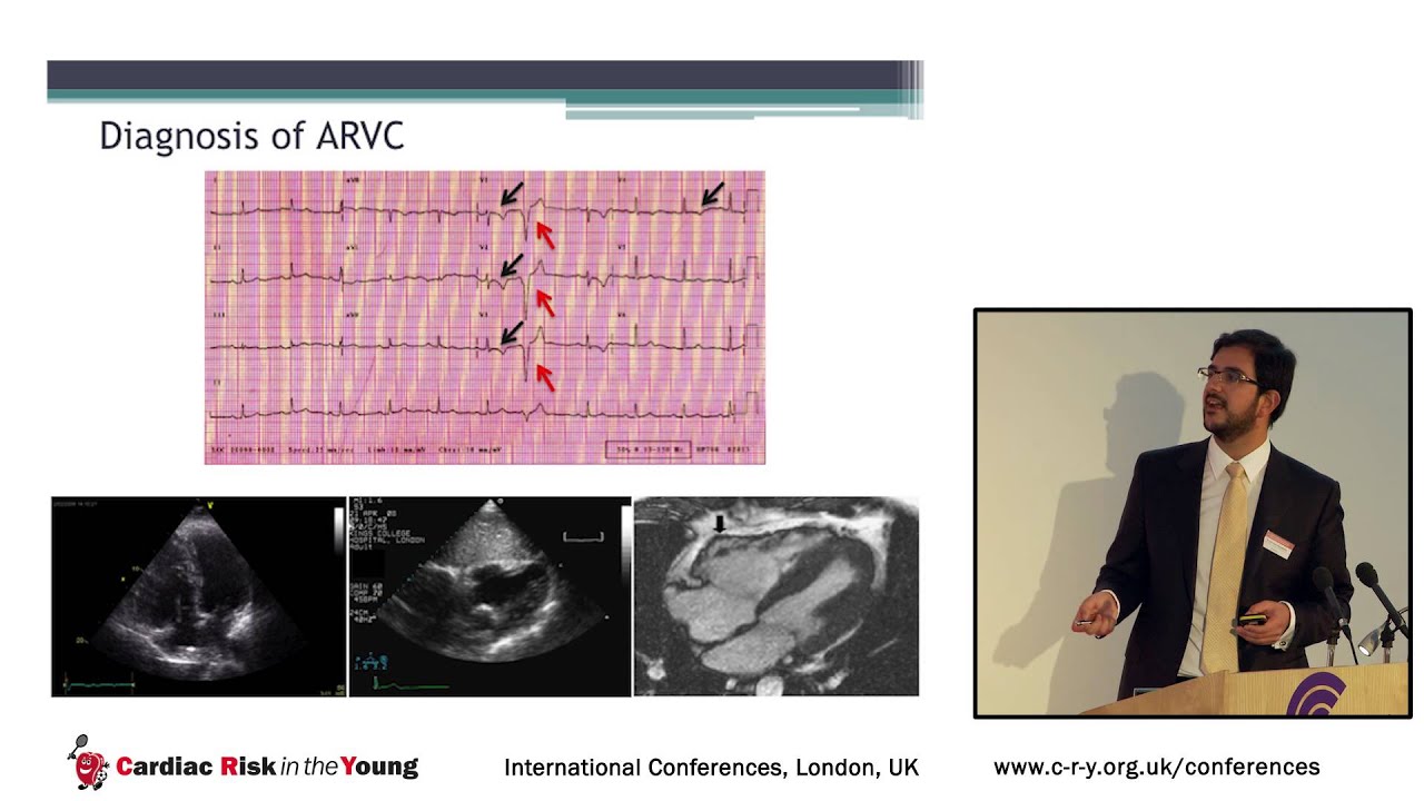 The role of exercise stress testing in the assessment of athletes; Beyond IHD
