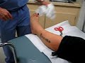 My broken leg My broken leg
