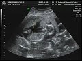 wilkinsonquints ultrasound 2 wilkinsonquints ultrasound 2
