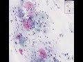 Histopathology Cervix--Low grade squamous intraepithelial le