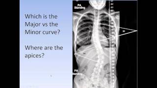 Scoliosis: How to medically classify scoliosis (the Lenke System for AIS)