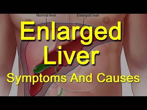 how to treat enlarged liver