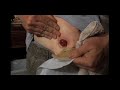 Urostomy wafer change