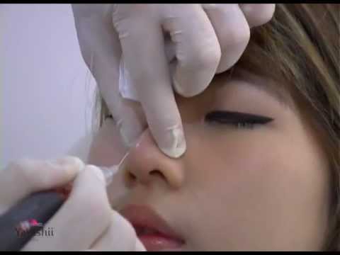 ฉีดจมูก - เสริมจมูก ปรับรูปคาง เติมปากอวบอิ่ม เติมร่องลึกข้างแก้ม-ใต้ตา ด้วย เทคโนโลยี Filler Injection Pen...