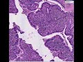 Histopathology Fallopian tube--Chronic salpingitis