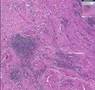 Histopathology Fallopian tube--Chronic salpingitis