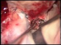 Transcavernous approach for invasive pituitary adenomas