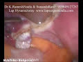 Laparoscopy Hysterectomy TLH LAVH Video (Lap Uterus Removal Laparoscopy Hysterectomy TLH LAVH Video (Lap Uterus Removal