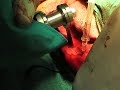 Avance de la tuberosidad tibial TTA