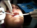 Mini Dental Implants - Single Tooth Replacement FIRST Technique