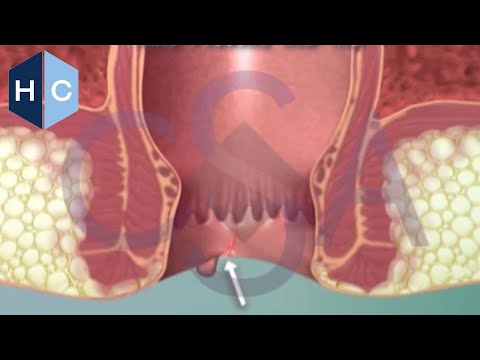 PERIANAL ABSCESS - http://www.houstoncolon.com/anal-abscess-texas Anal fistula is a an infected cavity filled with pus, found near the anus or rectum. Treatment consists of sur...