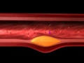 What is Plaque?