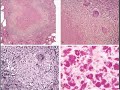 Medical School Pathology, Chapter 8n