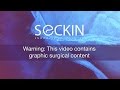 laparoscopic  Myomectomy