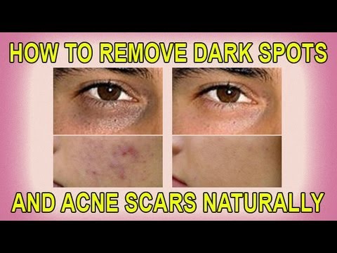 spots - BLOG: http://www.dhukai.com/how-to-remove-dark-spots-and-acne-scars/ FACEBOOK: http://www.facebook.com/farahdhukai TWITTER: http://www.twitter.com/farahdhuka...