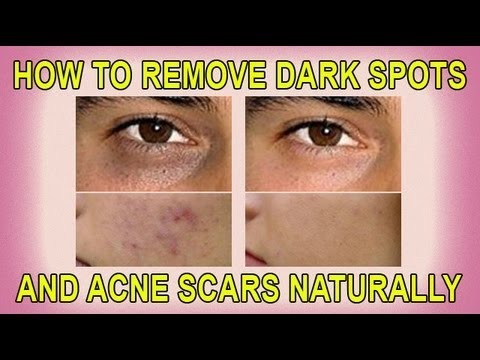 how to remove acne scars in a natural way