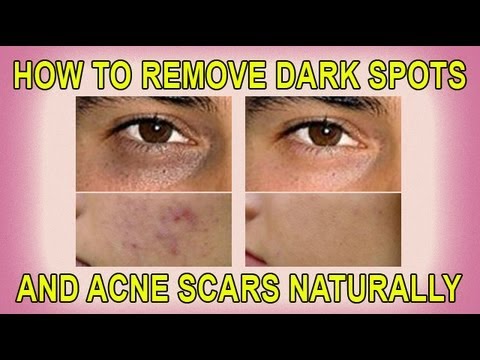 how to remove acne scars naturally