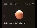 hysteroscopic-aspect-of-septate-uterus.html