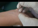 Ganglion Cyst Removal