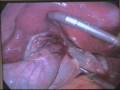 videos de Laparoscopic Cholecystectomy