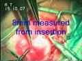 Lateral Rectus Recession Exotrop. SquintsurgeryDr.Sudhalkar Lateral Rectus Recession Exotrop. SquintsurgeryDr.Sudhalkar