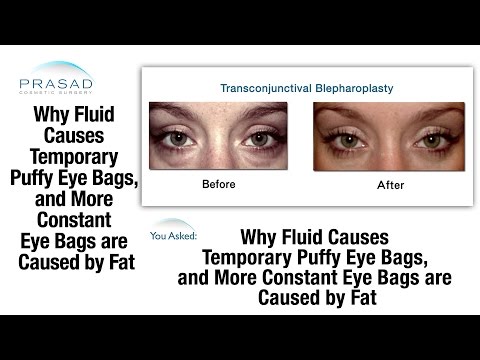 how to drain under eye bags