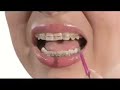 Braces or Invisalign? No Problem. Braces or Invisalign? No Problem.