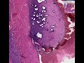 Histopathology Ovary--Endometriosis Histopathology Ovary--Endometriosis