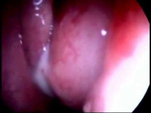 how to treat eosinophilic folliculitis